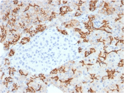 Formalin-fixed, paraffin embedded human pancreaticcarcinoma sections stained with 100 ul anti-TROP2 (clone TACSTD2/2153) at 1:200. HIER epitope retrieval prior to staining was performed in 10mM Citrate, pH 6.0.